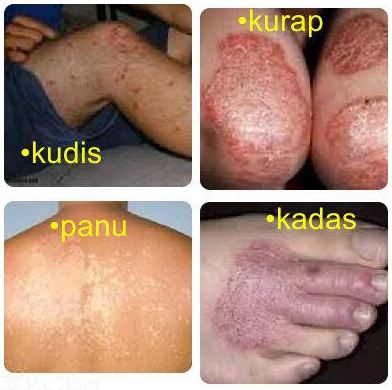 Panu Wajah Panu Wajah