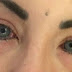 Modelo argentina perde mais da metade da visão após procedimento para mudar a cor dos olhos
