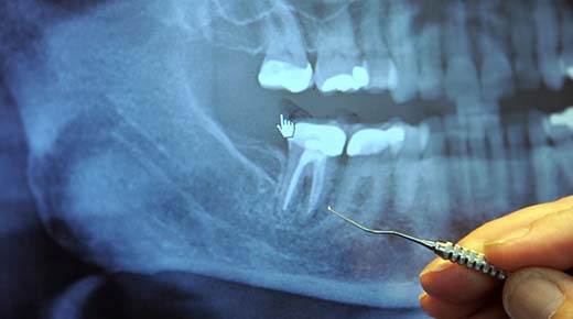 97% de todos los pacientes con cáncer terminal previamente fueron sometidos a este procedimiento dental... Diente%2Bprocedimiento%2Bdental%2Bcancer