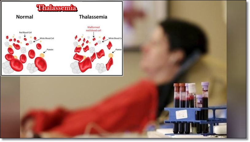 Pengobatan Alternatif Penyakit Thalasemia Secara Alami Sampai Tuntas Pengobatan Alternatif Penyakit Thalasemia Secara Alami Sampai Tuntas