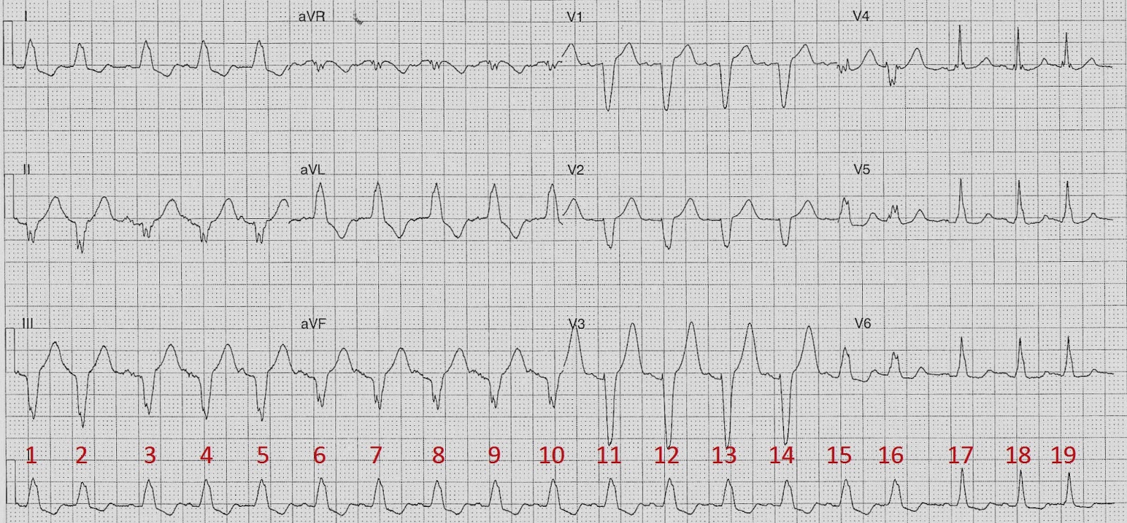 sinus rhythm ivcd sinus rhythm ivcd
