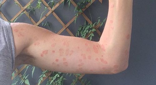 Obat Psoriasis Kulit di Apotek Obat Psoriasis Kulit di Apotek
