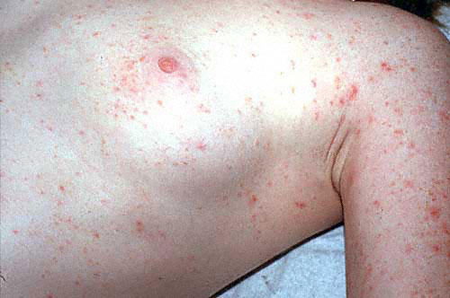 Scabies - health.vic