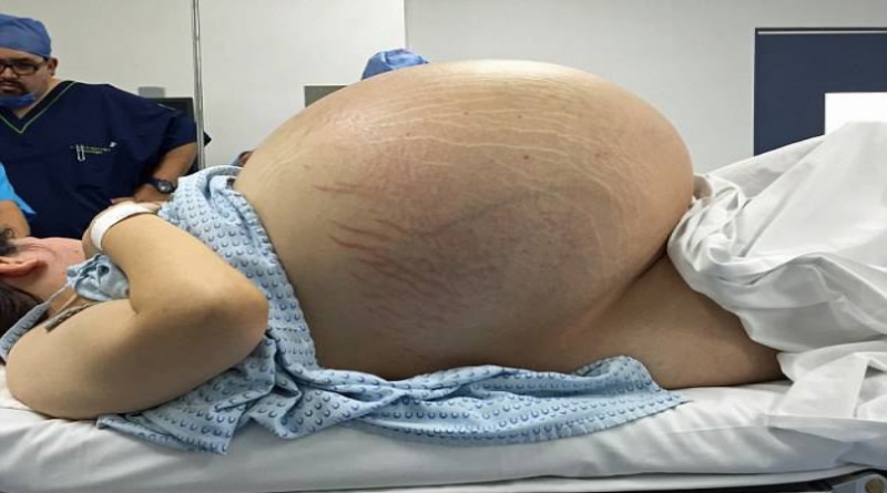 dieta per cisti ovariche dieta per cisti ovariche