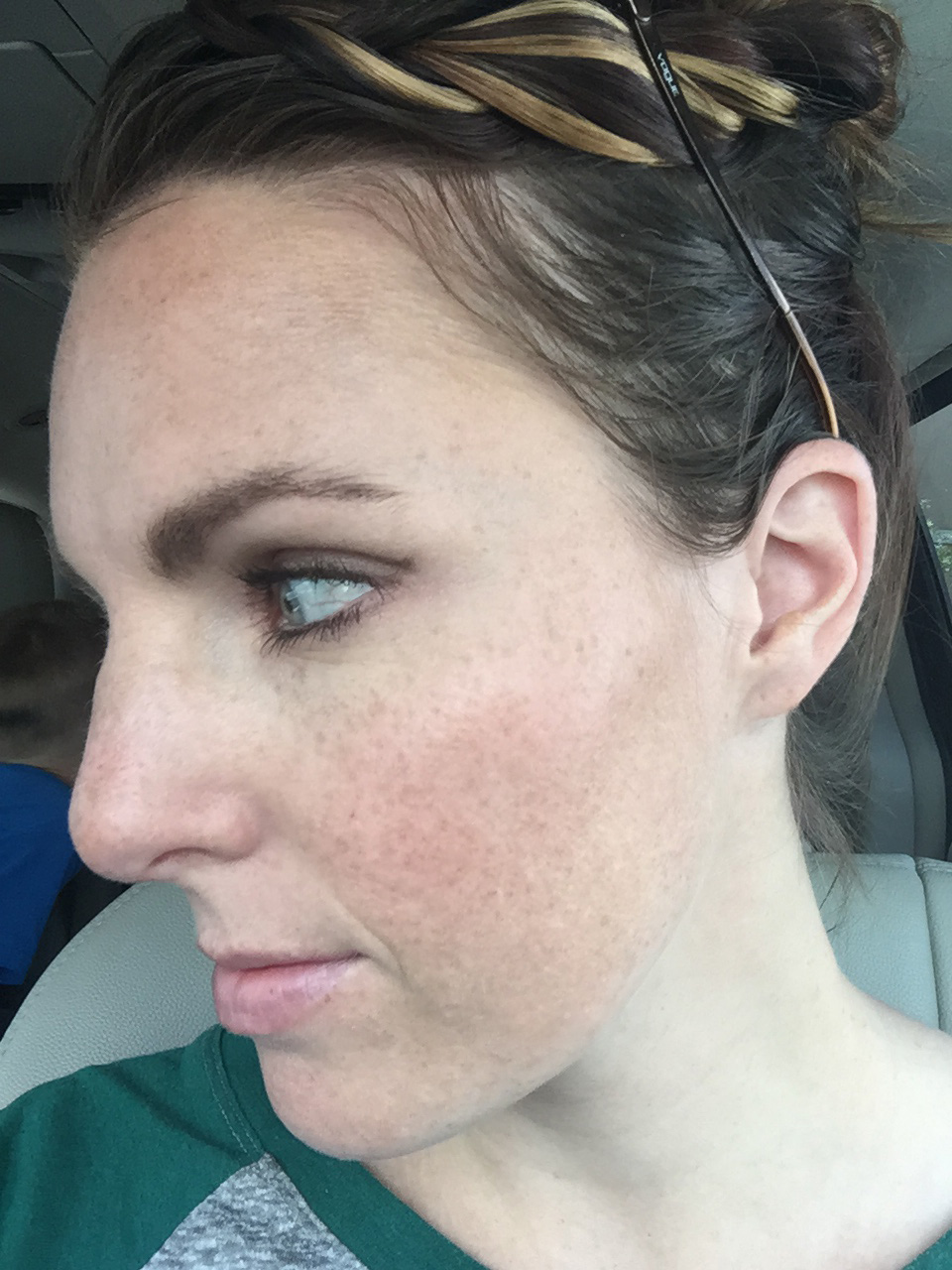 topical retinoid cream for freckles