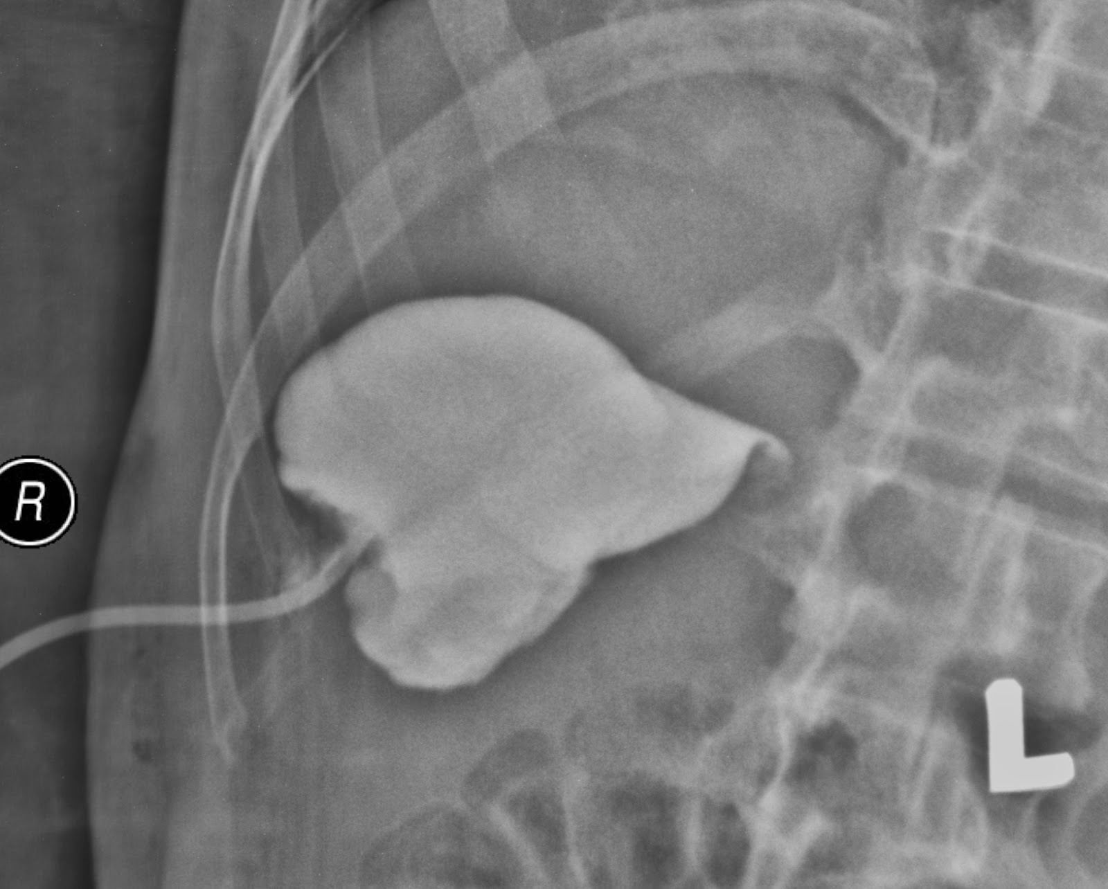 DrRattawachIR: ซิสต์ในไต (Kidney cyst)