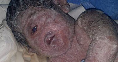 baby born with one eye egypt