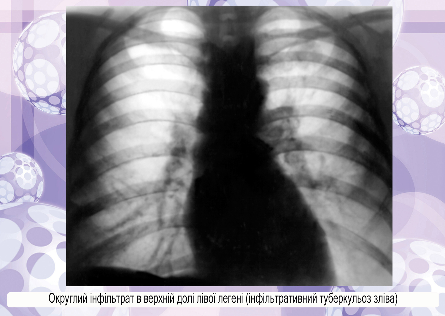Солидный узел в легких. Инфильтративный туберкулез рентгенограмма. Рентгенография грудной клетки при инфильтративный туберкулез. Очаговый туберкулез рентгенограмма. Рентгенография грудной клетки при инфильтрация туберкулез.