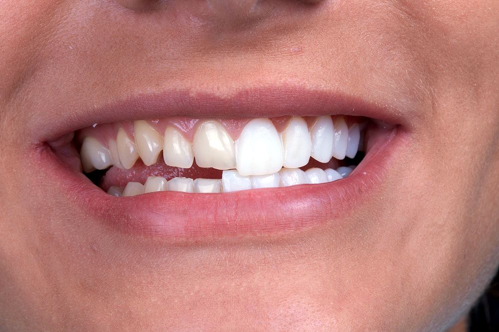 The Benefits of Porcelain Veneers Directorio Odontológico