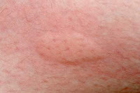 Hautentzündung, die Wahrheit hinter den Auslösern