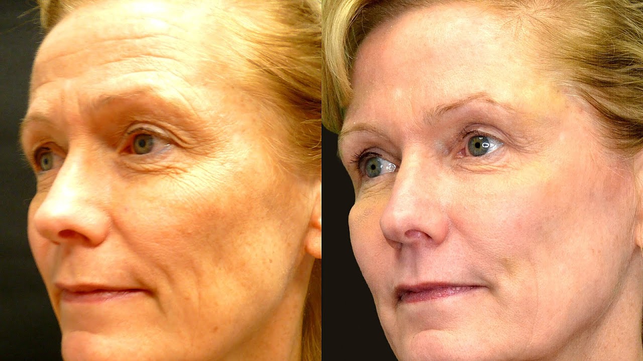 Side Effects To Botox Effect Choices