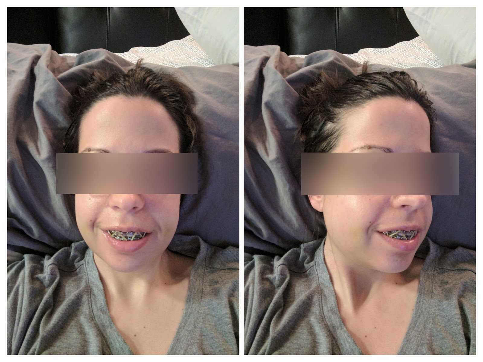 My Story Double Jaw Surgery and Septoplasty Photos
