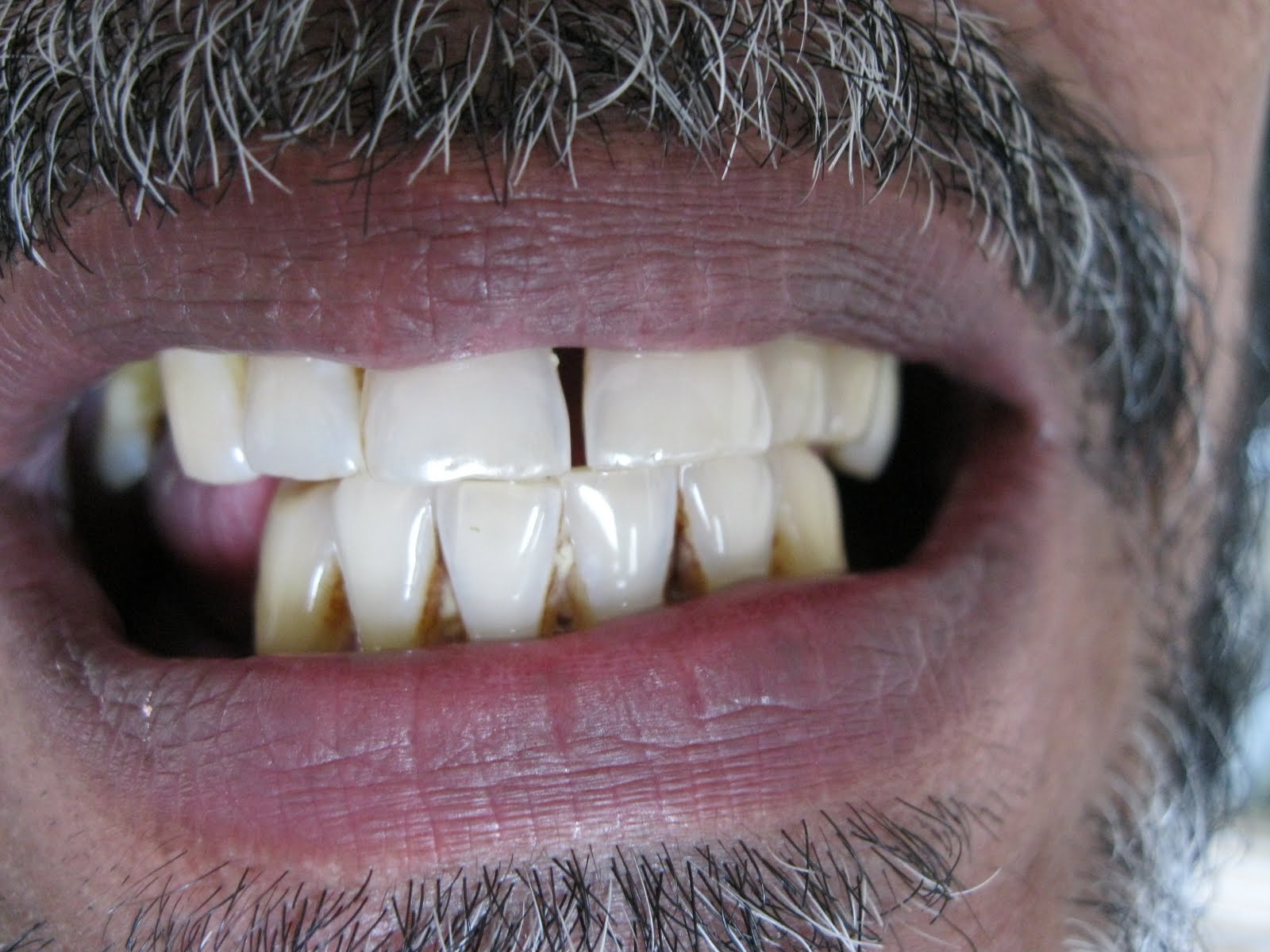 DENTO CARE DENTAL CLINICS FLEXIBLE DENTURES as IMMEDIATE