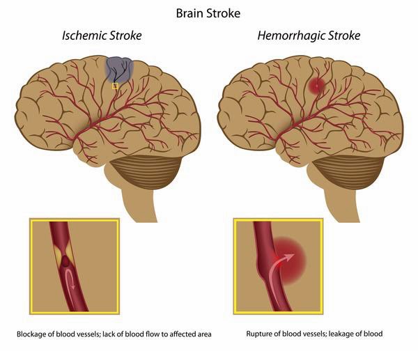 "Had a Dad" Alzheimer's Blog Stroke damage = vascular dementia