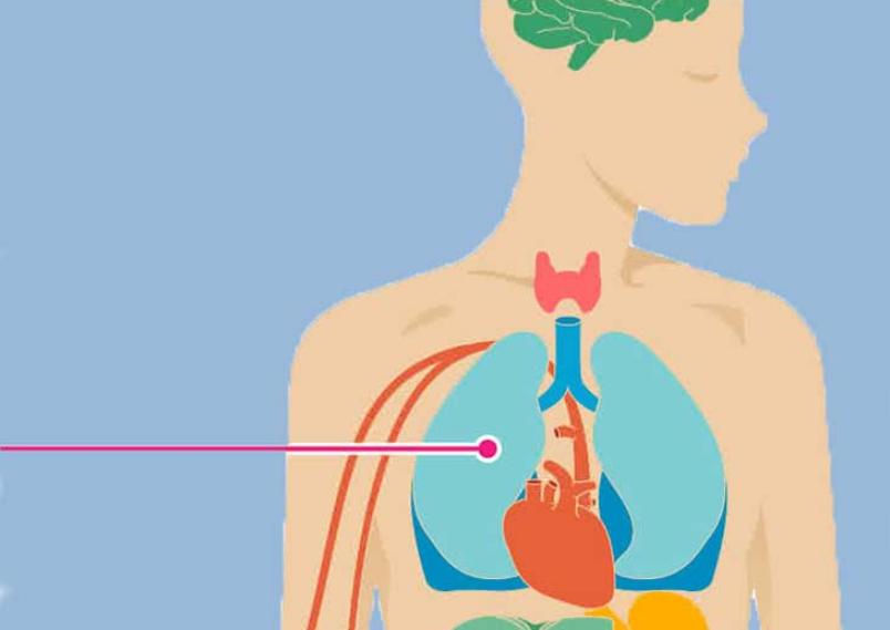 Lung Cancer With Brain Mets Prognosis