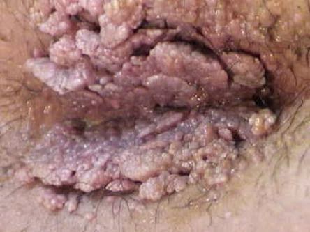 Penyebab Penyakit Hpv