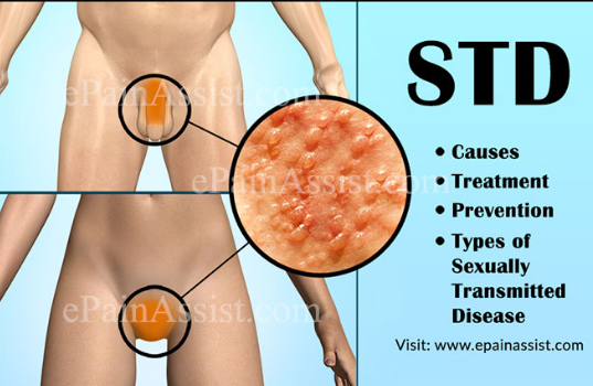 Sexually transmitted disease