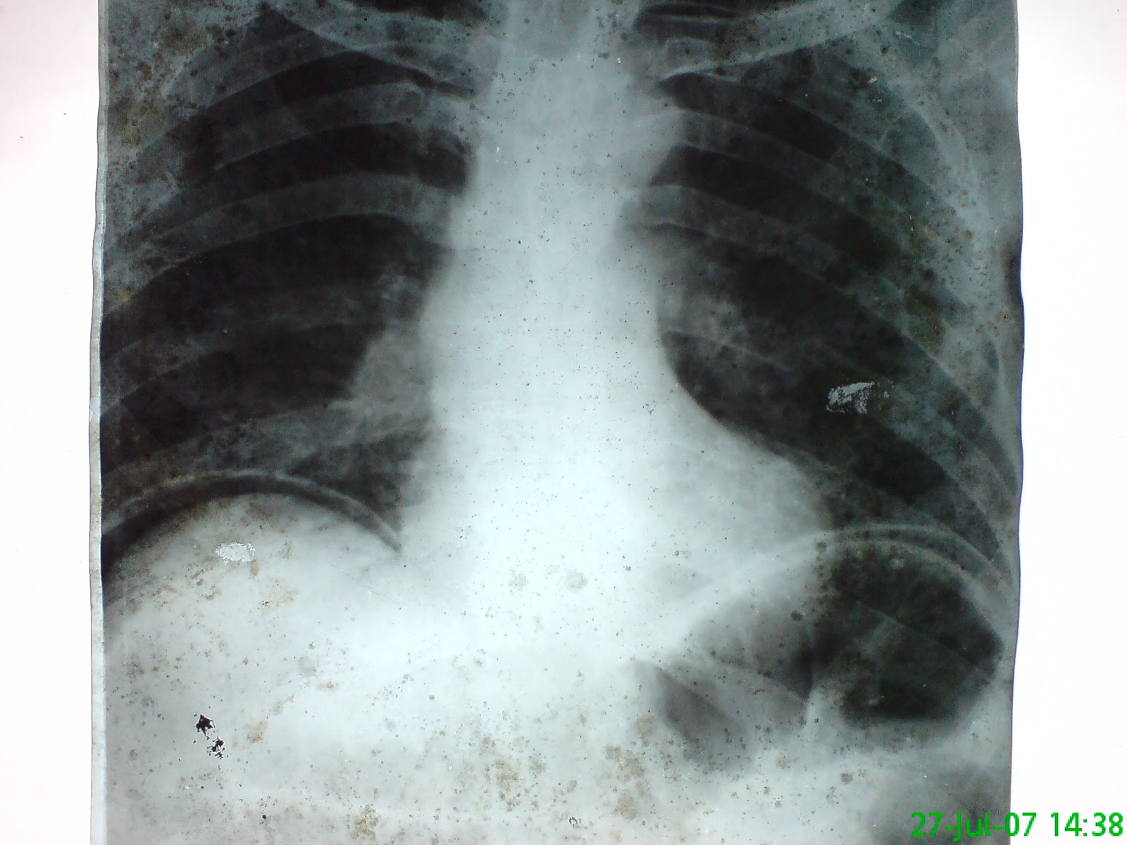 General Surgery Clinics ~ A Surgeon #39 s Blog: Causes of Free Gas Under