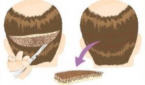 Hair Transplantation in India with High Quality and Affordable Price
