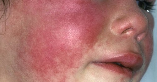 Best of Can strep throat rash penis 4 blacks face fucking white woman
