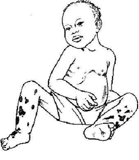 क्वाशियोरकर (Kwashiorkor)