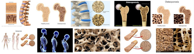 10 Daftar Makanan Terbaik Yang Dapat Mencegah osteoporosis pada manula