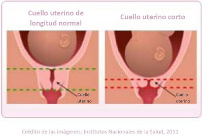 Riesgo de parto prematuro: cérvix o cuello uterino corto
