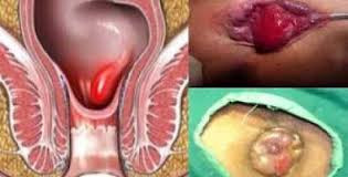 Foto Obat wasir berdarah herbal cepat sembuh di apotik jakarta
