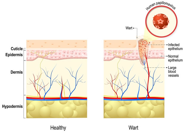 Genital warts illustration