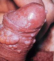 Penyebab penis bengkak dan gatal Penyebab penis bengkak dan gatal