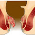 Obat Tradisional Ambeien Atau Wasir thumbnail