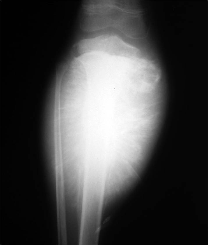 Periosteal reaction for the Radiology Residents Sumer's Radiology Blog