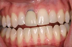Bọc răng sứ tránh khỏi tổn thương do hư răng Images%2B%25287%2529