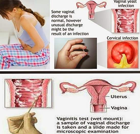 Punca & cara atasi masalah keputihan, sebab dan tanda-tanda berlakunya keputihan, penyakit keputihan, cara tangani masalah keputihan, cara elak keputihan, kesan buruk keputihan, cara cegah keputihan, penyelesai masalah keputihan, cara cuci vagina yang betul