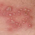 HERPES GENITAL (HERPES SIMPLEX) thumbnail