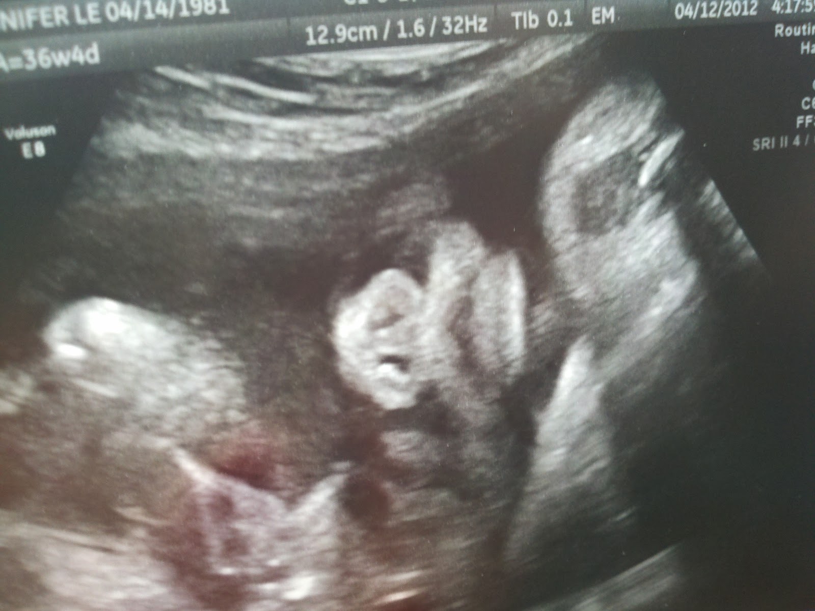 the S&J post 9 month Ultrasound