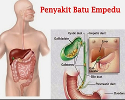 Perbedaan Batu Ginjal Dan Batu Empedu, Penyebab, Gejala Serta Ramuan Herbal Untuk Mengatasinya Secara Lengkap Perbedaan Batu Ginjal Dan Batu Empedu, Penyebab, Gejala Serta Ramuan Herbal Untuk Mengatasinya Secara Lengkap