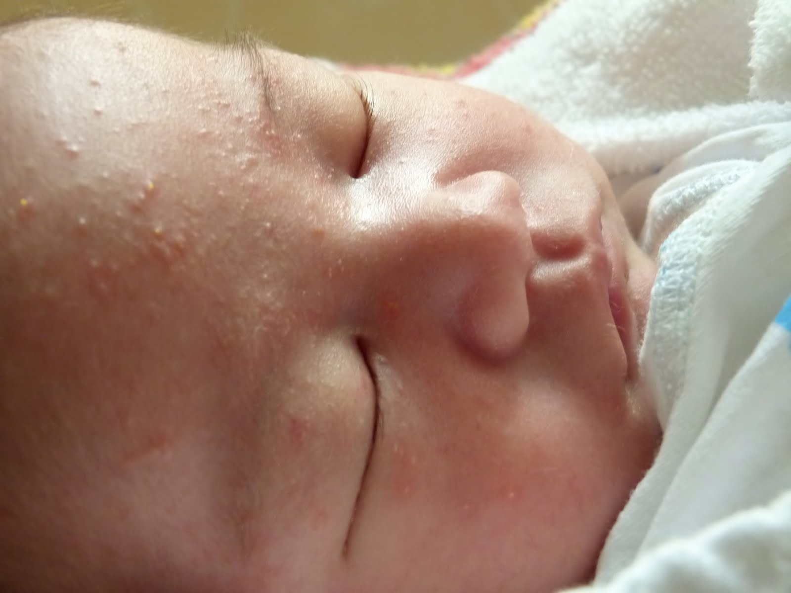 Почему у новорожденного может быть. Неонатальный цефалический пустулез. Цефалический пустулез новорожденных. Неонатальное акне у новорожденных. Акне новорожденных (младенческие угри, неонатальный пустулез).