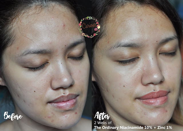 The Ordinary Niacinamide 10 Zinc 1 Vorher Nachher curiousaboutbeauty.blogspot.com
