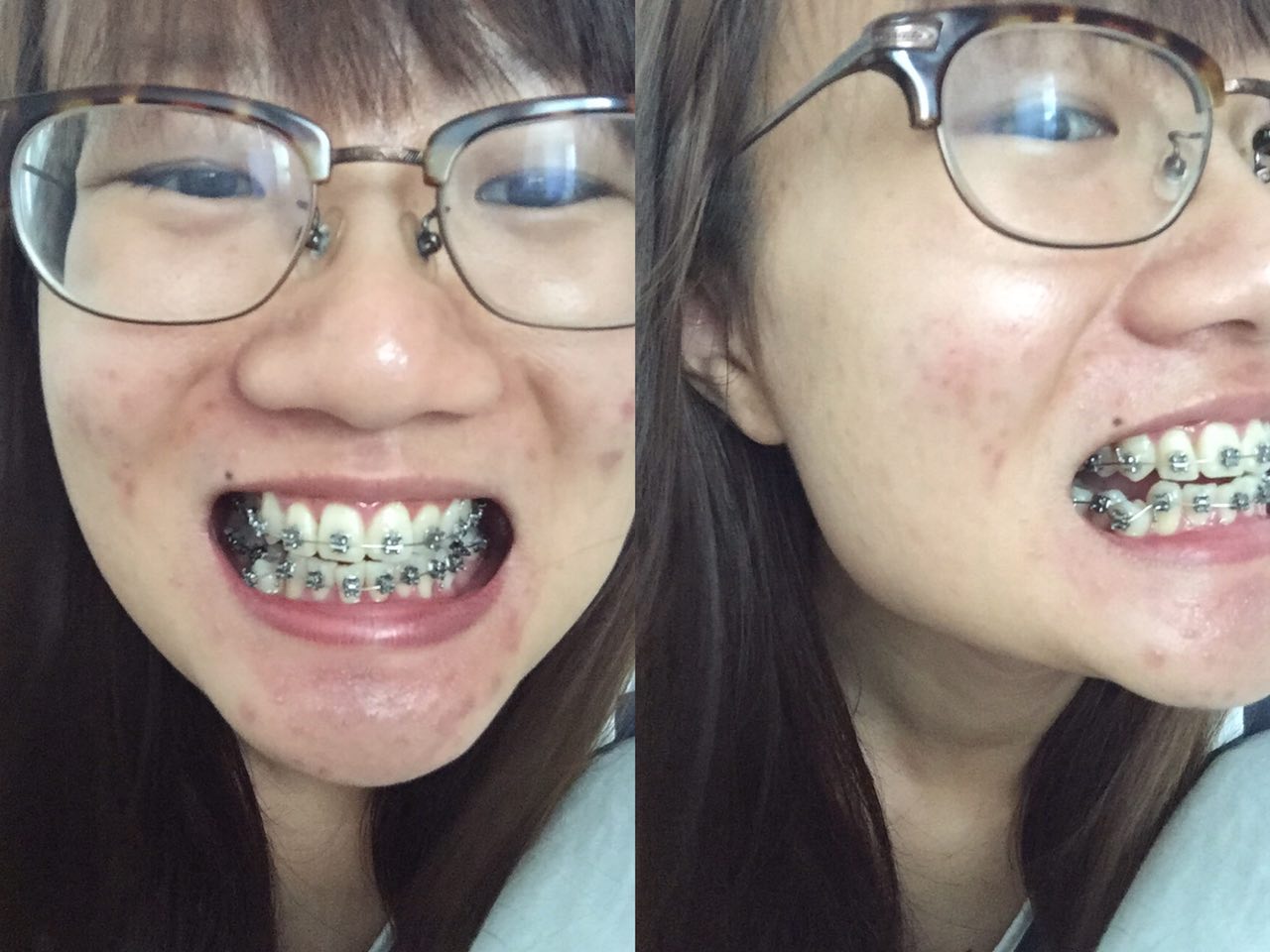 Amanda A. My Braces Journey (Putting on Braces!)