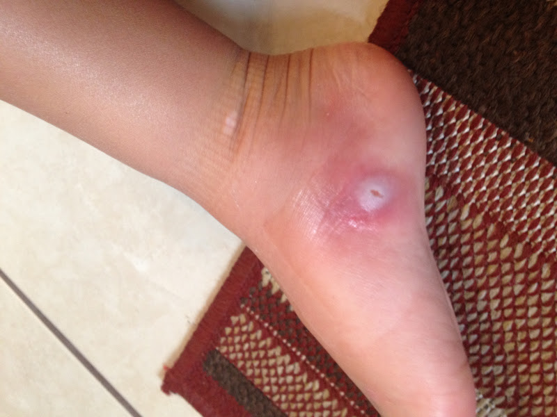 Courtright Family Strep, Stitches, Staples, and Splinters