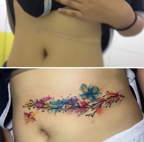 LOOK: Tattoo Artists Create A Masterpiece By Covering Up These Huge Scars With A Stunning Tattoo! LOOK: Tattoo Artists Create A Masterpiece By Covering Up These Huge Scars With A Stunning Tattoo!