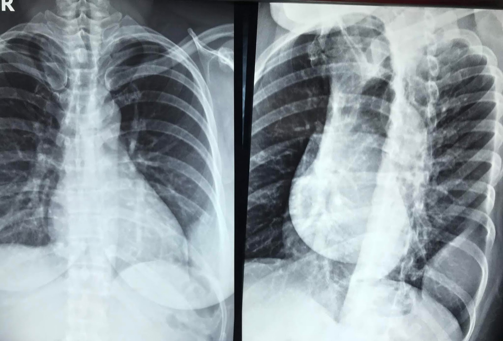 VIETNAMESE MEDIC ULTRASOUND CASE 541 RIB TUMOR, Dr PHAN THANH HAI, Dr