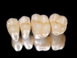 răng sứ titan có tuổi thọ bao nhiêu năm
