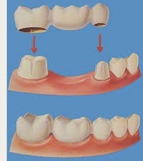 Τι είναι η οδοντιατρική γέφυρα και τι πρέπει να προσέχουμε; Image1
