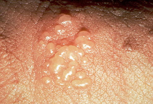Love all Folliculitis in folds of the vulva just