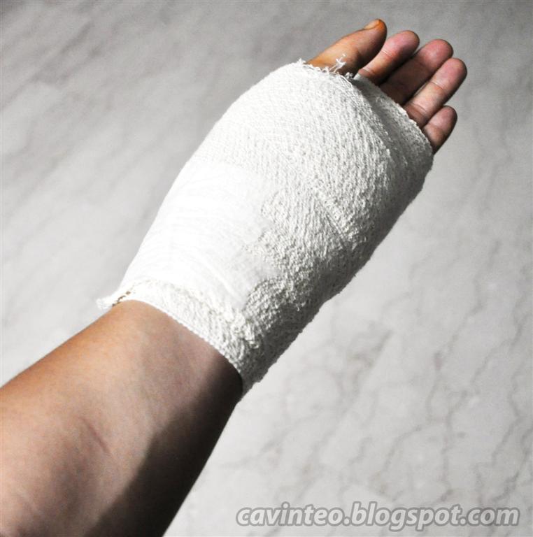 Entree Kibbles My Wrist Surgery for De Quervain's Tendinitis Khoo