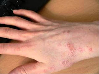 scabies-www.healthnote25.com