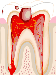 Pulpitis or Toothache