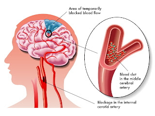 obat herbal untuk mengobati stroke berat obat herbal untuk mengobati stroke berat, obat herbal untuk mengobati stroke, obat herbal mengobati stroke berat